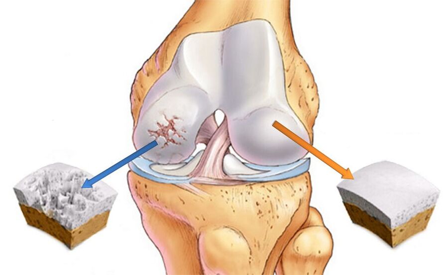 Arthrose de l'articulation du genou et cartilage sain. 