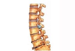Étapes du développement de l'ostéochondrose cervicale