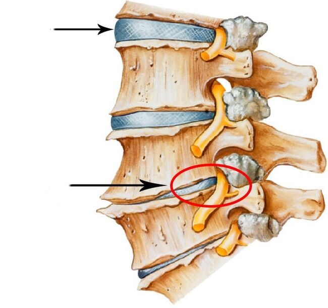 Disco Hernia Development