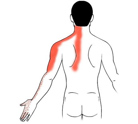 L'ostéochondrose cervicale comme cause de douleurs dans les articulations des doigts